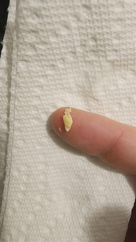 hairy gooch|Ingrown hair on my gooch. : r/popping .